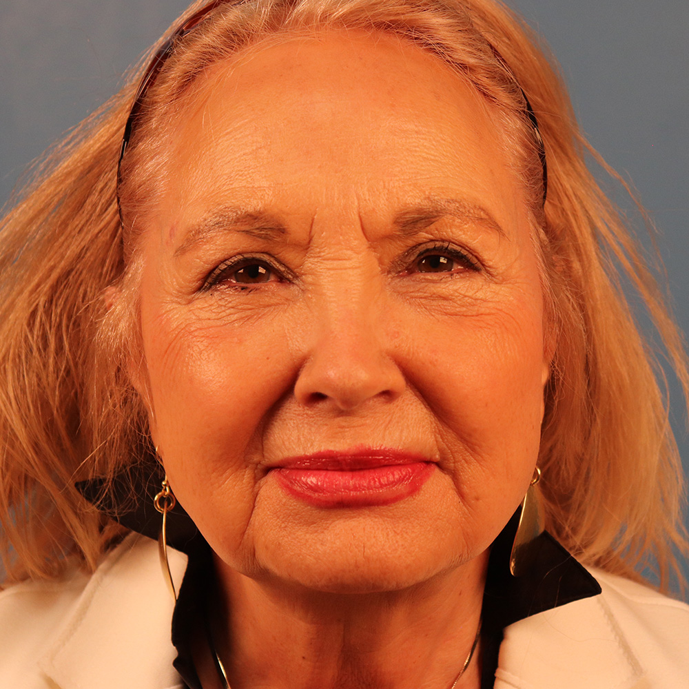 Case--2298 | Before Facelift