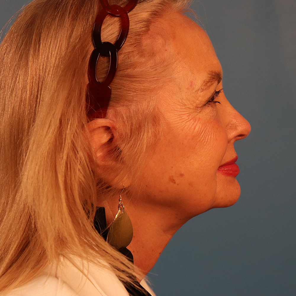 Case--2298 | Before Facelift 2