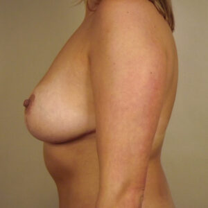 Case--5142 | After Breast 2