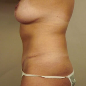 Case--8791 | After Abdominoplasty 2