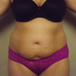 Case--8791 | Before Abdominoplasty 1