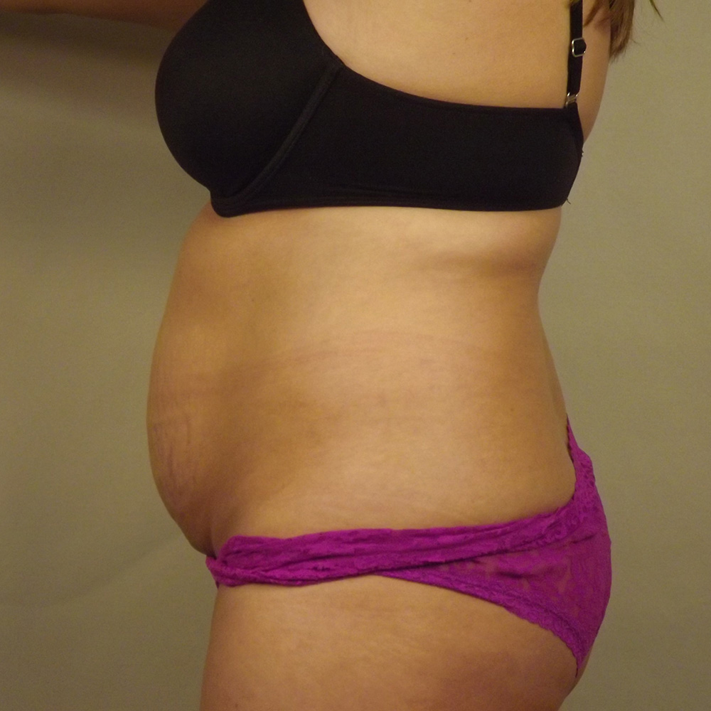 Case--8791 | Before Abdominoplasty 2