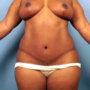 Case--1063 | After Abdominoplasty 1