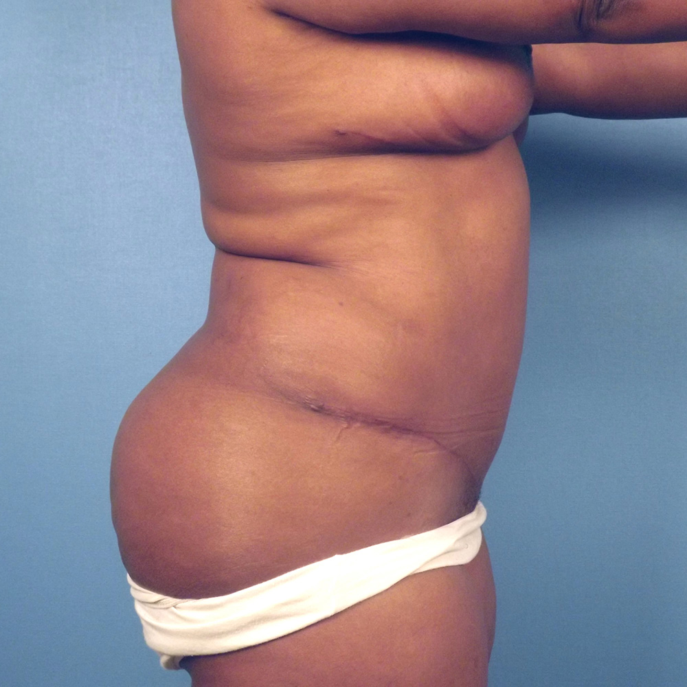 Case--1063 | After Abdominoplasty 2
