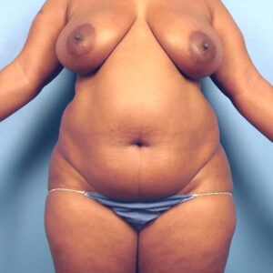 Case--1063 | Before Abdominoplasty 1