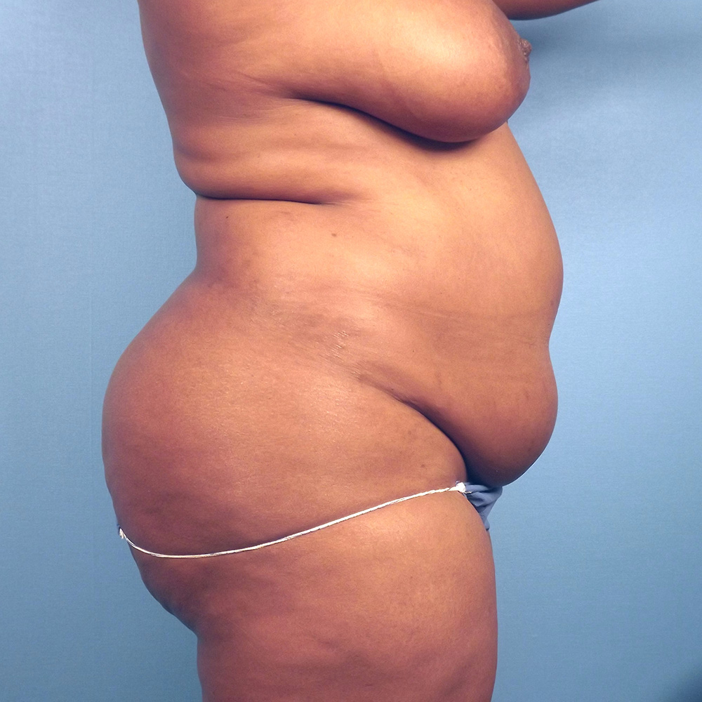 Case--1063 | Before Abdominoplasty 2