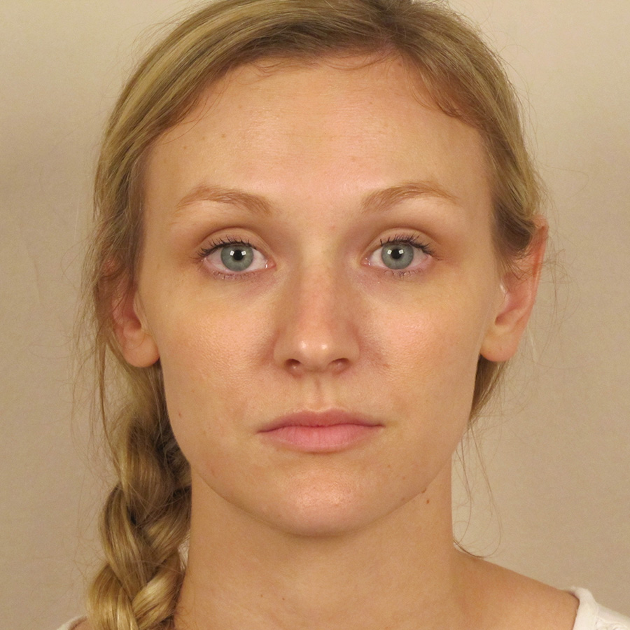 Case--6815 | Before Rhinoplasty