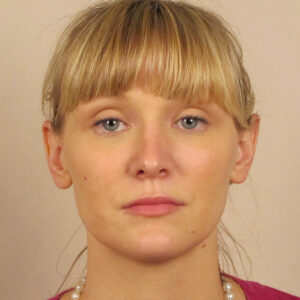 Case--6815 | After Rhinoplasty 1