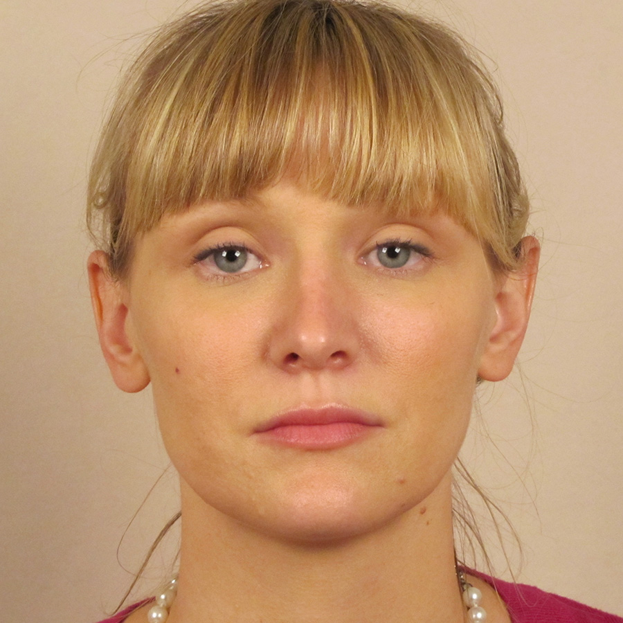 Case--6815 | After Rhinoplasty