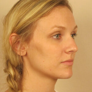 Case--6815 | Before Rhinoplasty 2