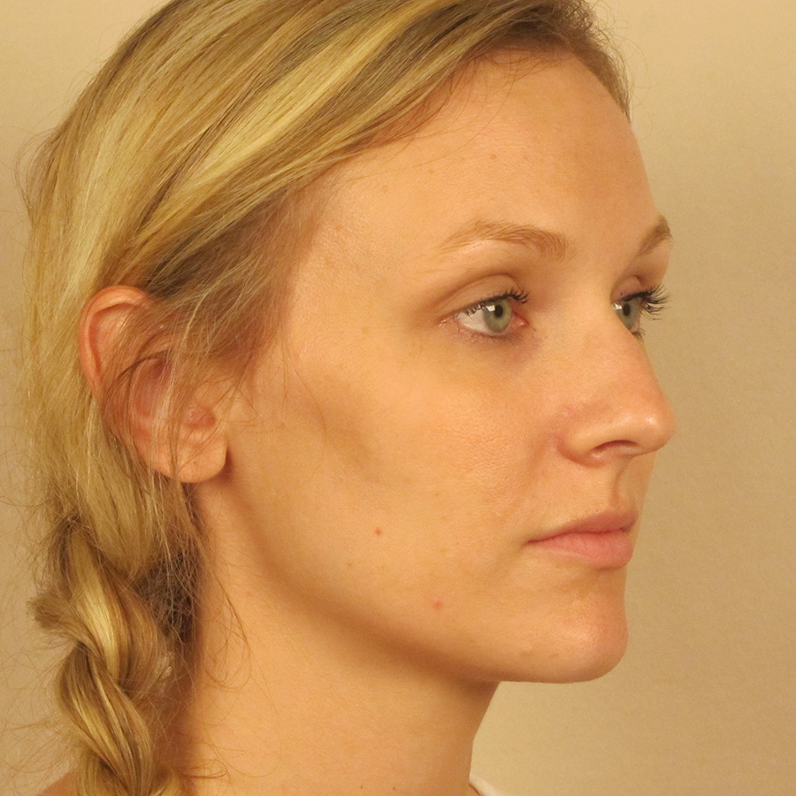 Case--6815 | Before Rhinoplasty 2