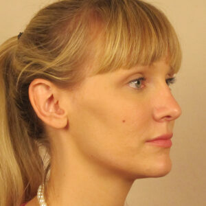 Case--6815 | After Rhinoplasty 2
