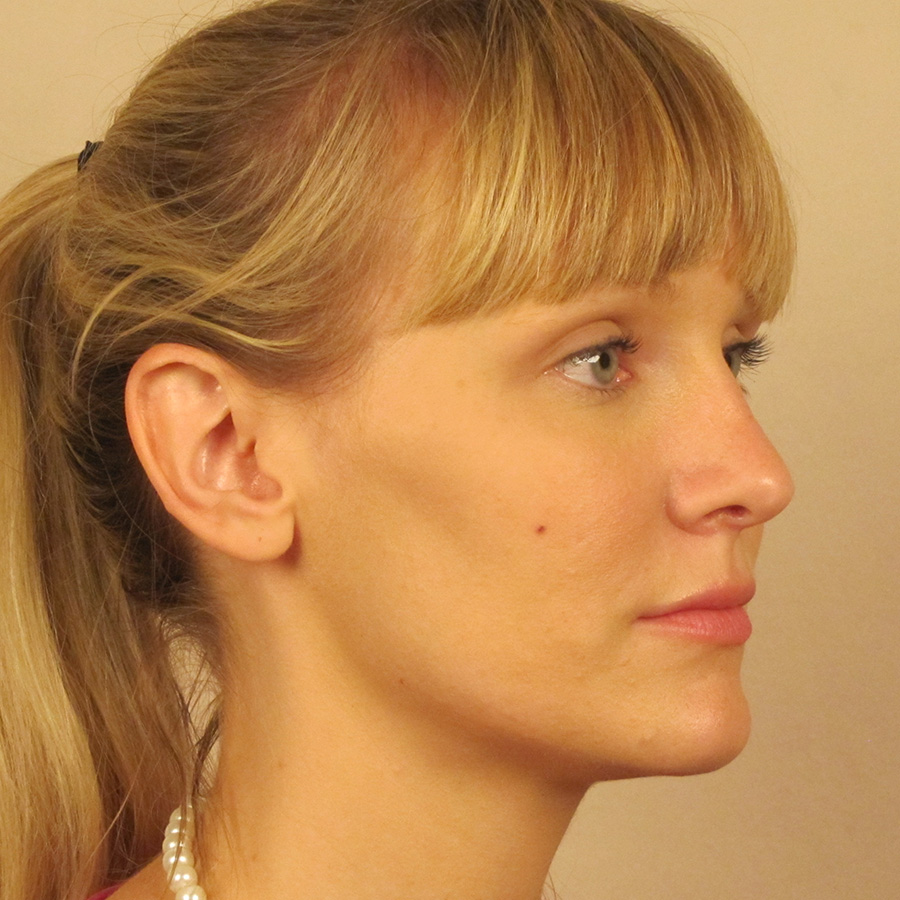 Case--6815 | After Rhinoplasty 2