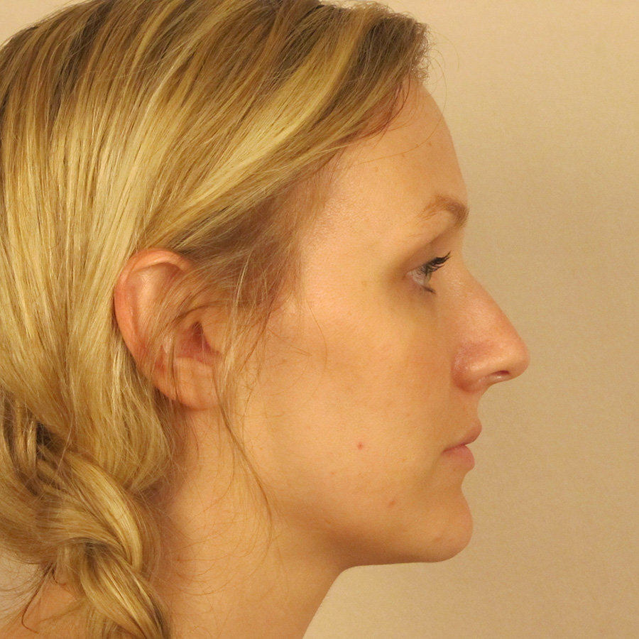 Case--6815 | Before Rhinoplasty 3