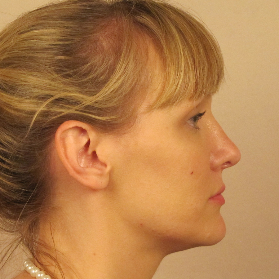 Case--6815 | After Rhinoplasty 3