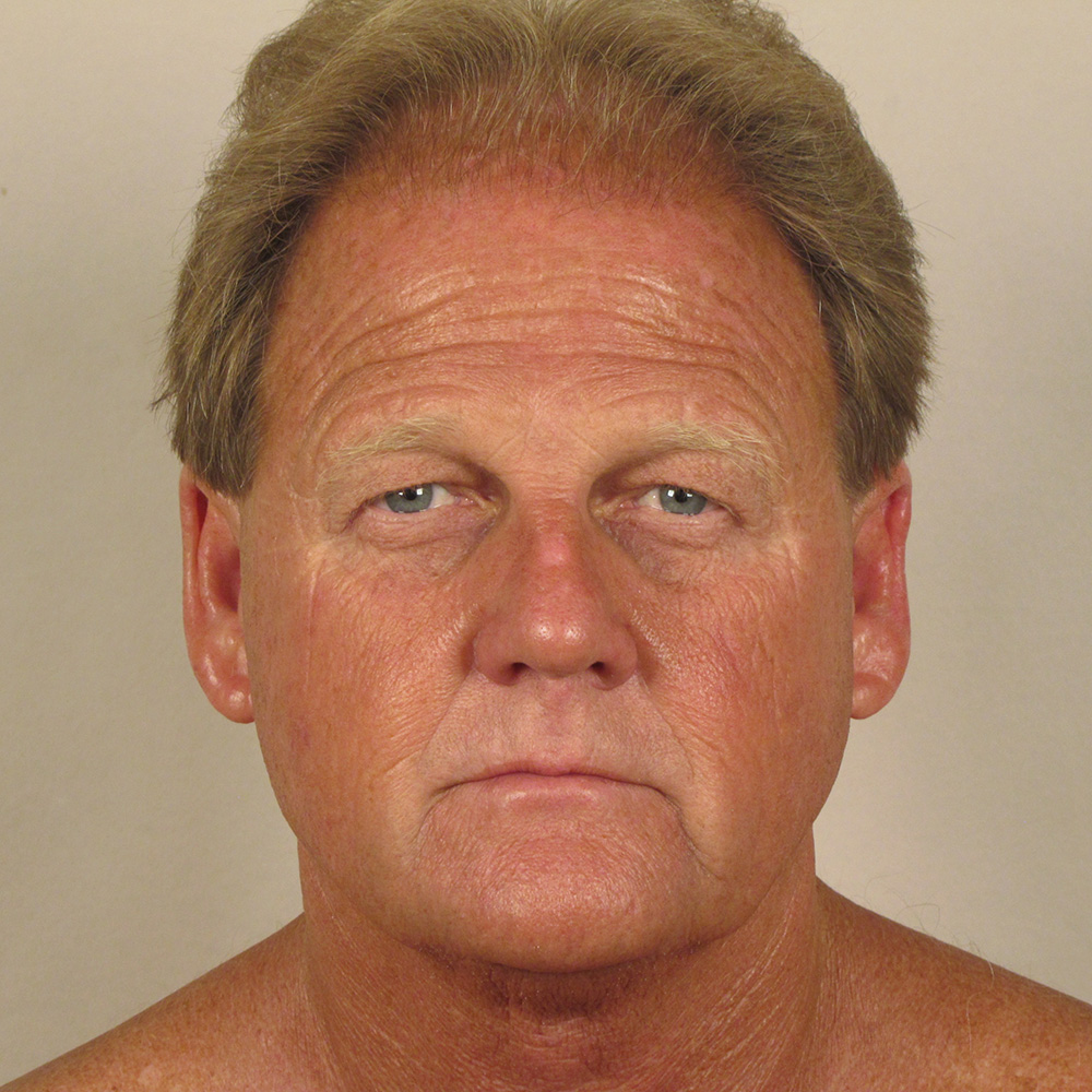 Case--8749 | Before Facelift