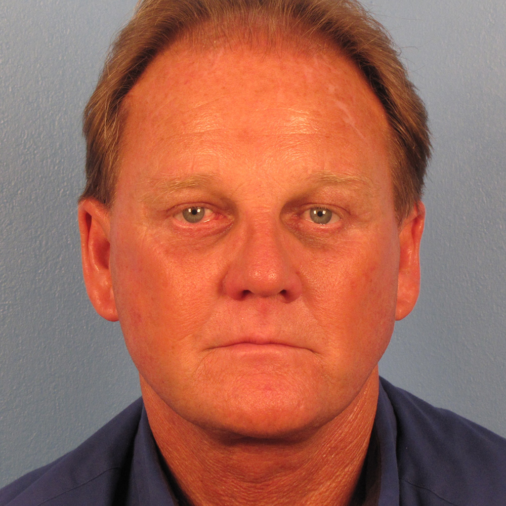 Case--8749 | After Facelift