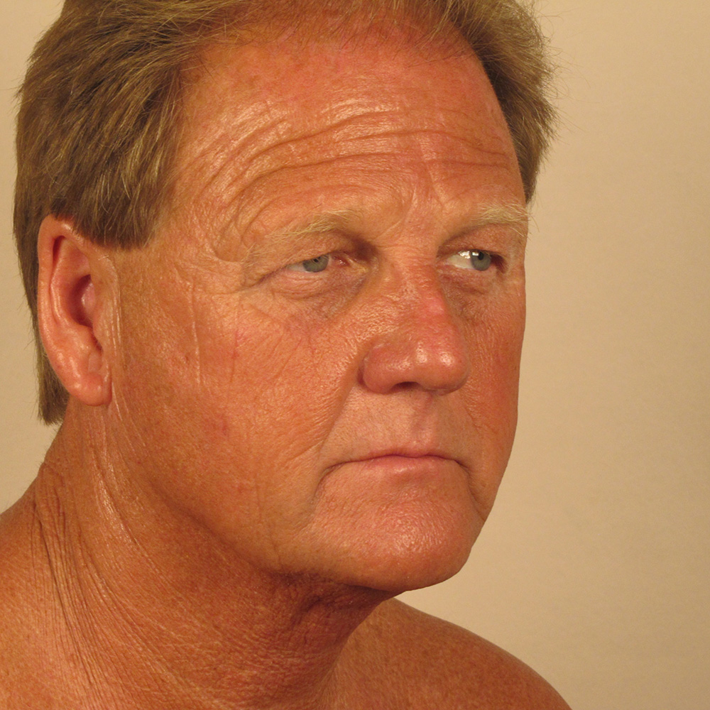 Case--8749 | Before Facelift 2