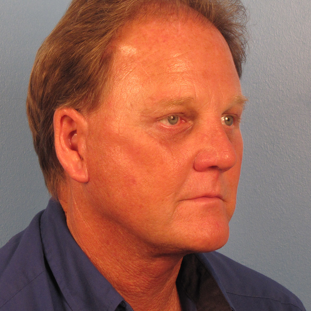 Case--8749 | After Facelift 2