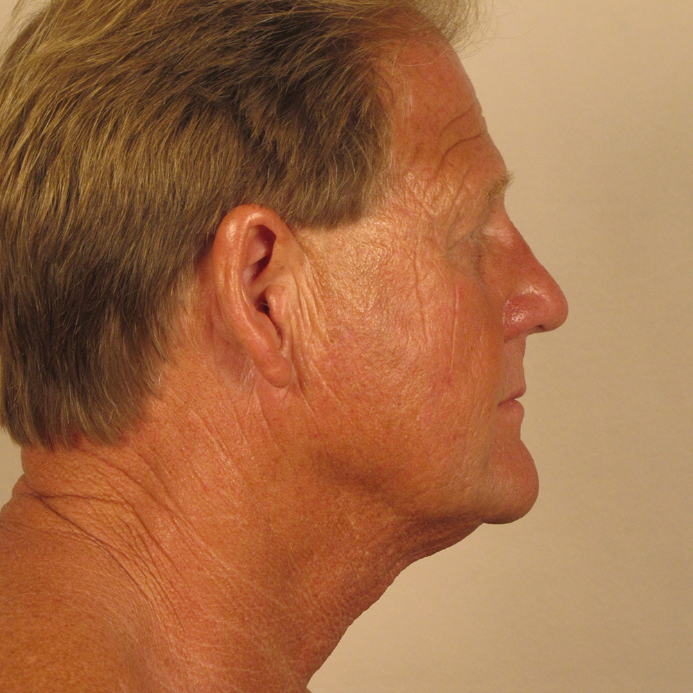 Case--8749 | Before Facelift 3