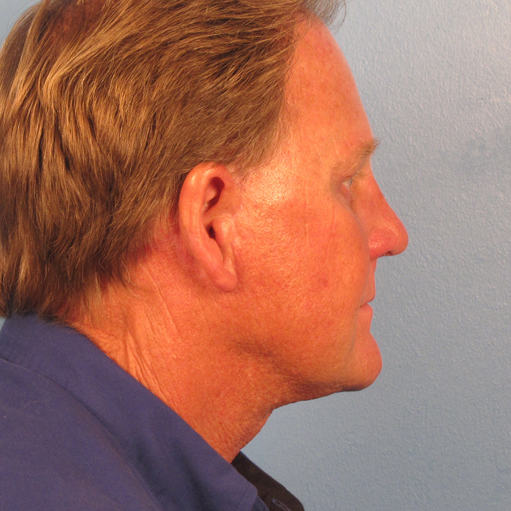 Case--8749 | After Facelift 3