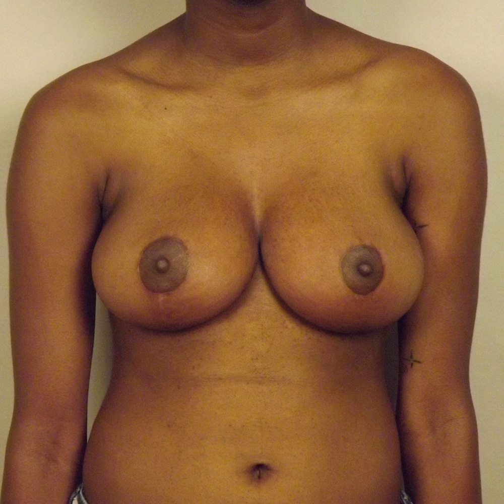 Case--7353 | After Bilateral Reduction Mammaplasty (Breast Reduction)