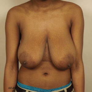 Case--7353 | Before Bilateral Reduction Mammaplasty (Breast Reduction) 1