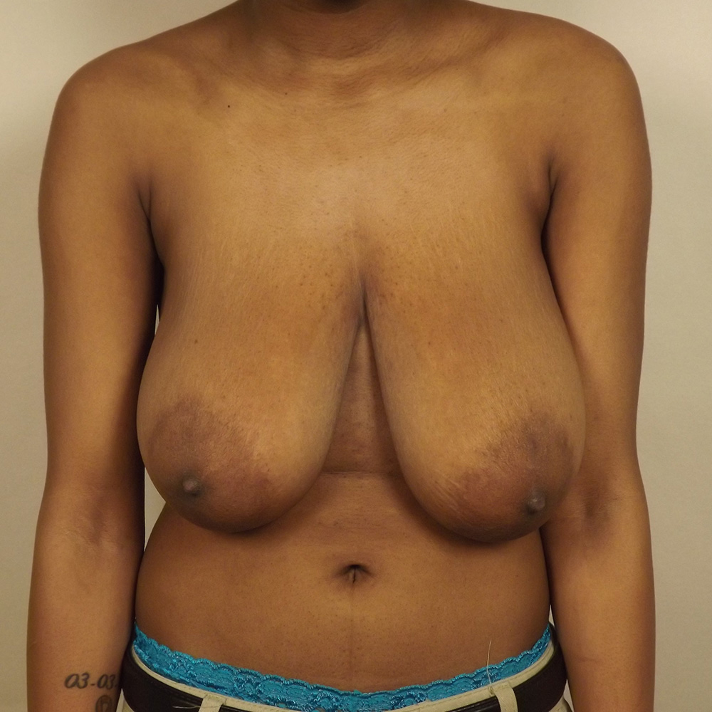 Case--7353 | Before Bilateral Reduction Mammaplasty (Breast Reduction)
