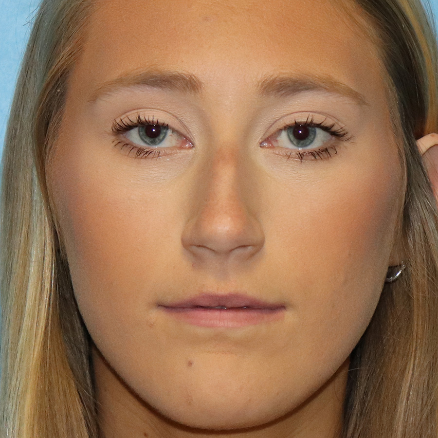 Case--9634 | Before Rhinoplasty