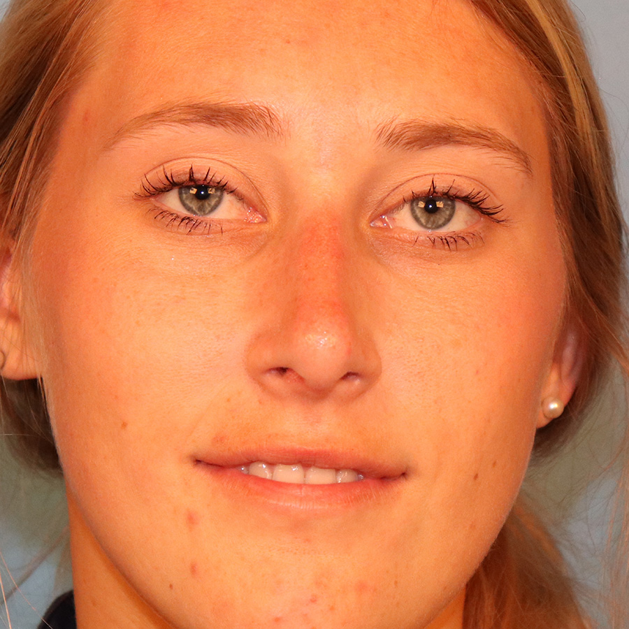 Case--9634 | After Rhinoplasty