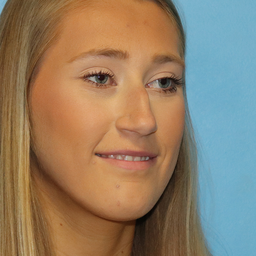 Case--9634 | Before Rhinoplasty 2