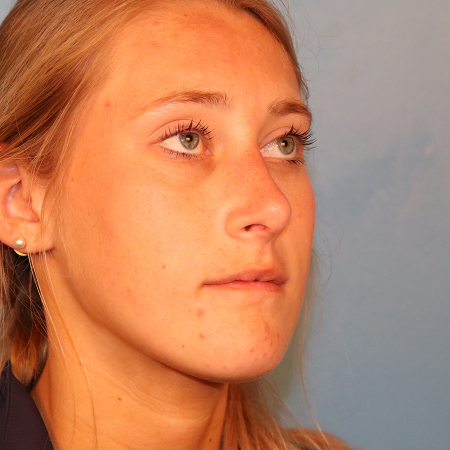 Case--9634 | After Rhinoplasty 2