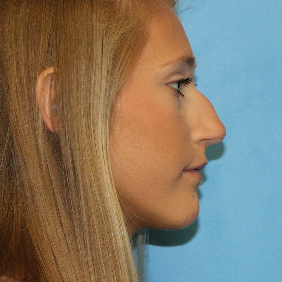 Case--9634 | Before Rhinoplasty 3