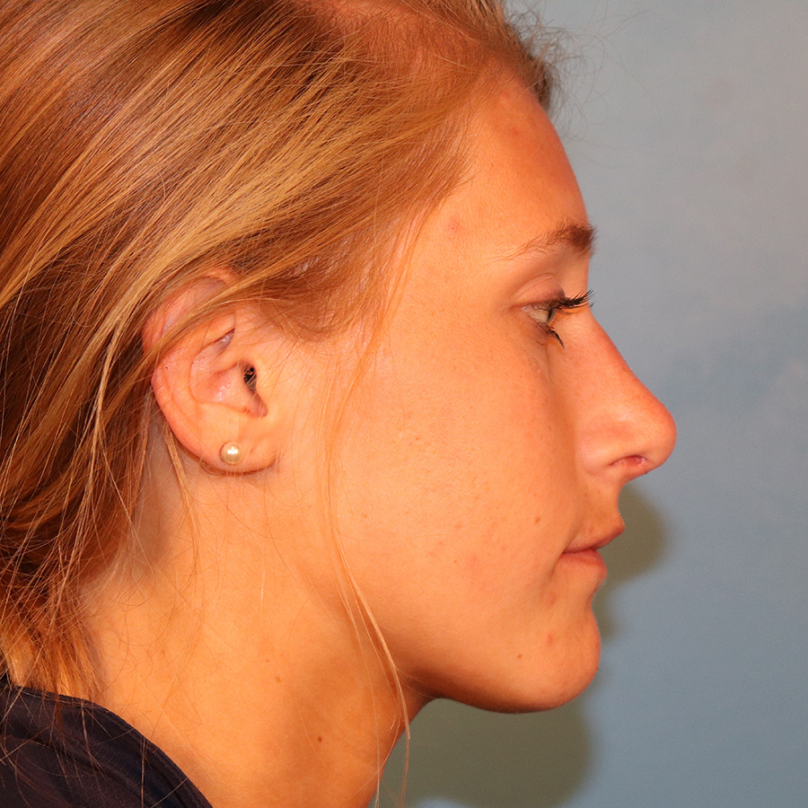 Case--9634 | After Rhinoplasty 3