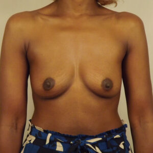 Case--3226 | Before Breast 1