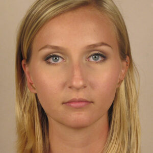 Case--2379 | Before Rhinoplasty 1