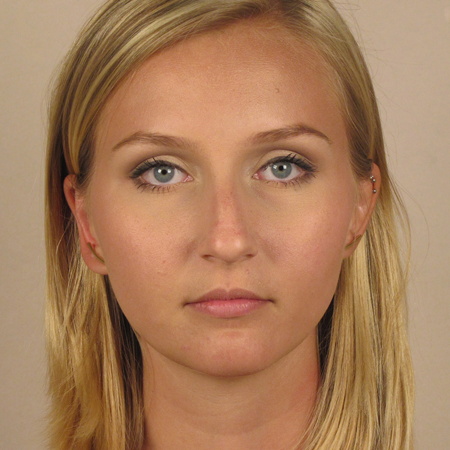 Case--2379 | Before Rhinoplasty