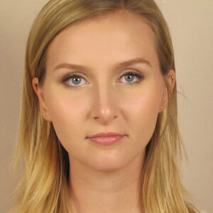 Case--2379 | After Rhinoplasty 1