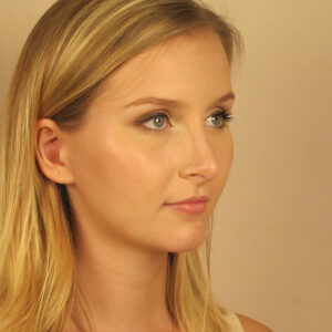 Case--2379 | After Rhinoplasty 2