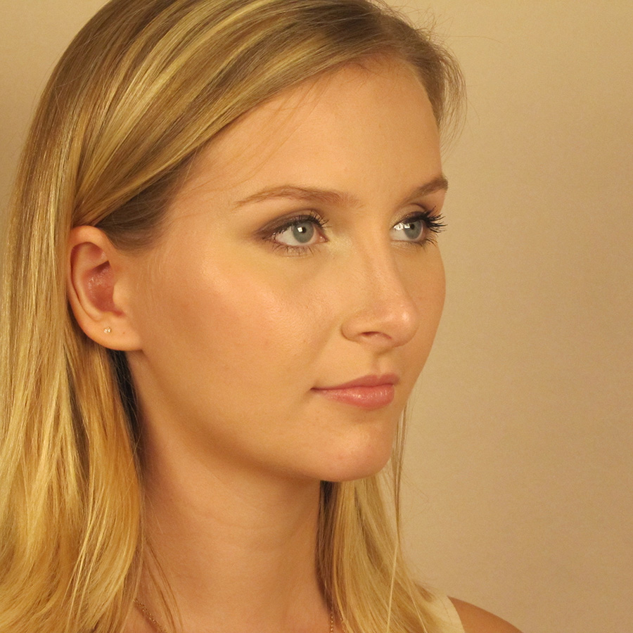 Case--2379 | After Rhinoplasty 2