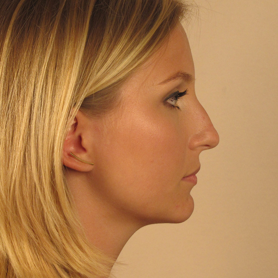 Case--2379 | Before Rhinoplasty 3