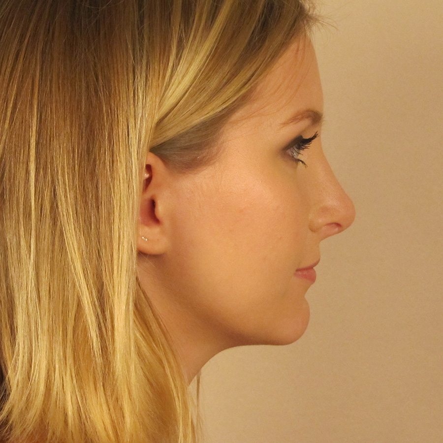 Case--2379 | After Rhinoplasty 3