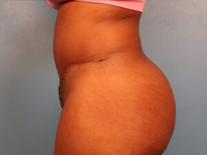 Case--52221 | After Tummy Tuck (Abdominoplasty) 2