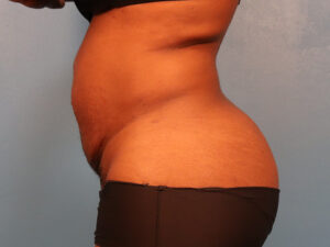 Case--52221 | Before Tummy Tuck (Abdominoplasty) 2