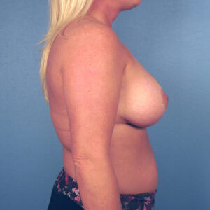 Case--8450 | After Augmentation Mastopexy 2