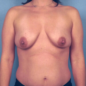 Case--7489 | Before Augmentation Mastopexy 1