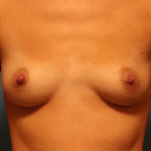 Case--2047 | Before Breast 1