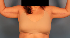 Case--57575 | After Arm Lift (Brachioplasty) 1