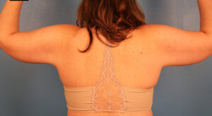 Case--57575 | After Arm Lift (Brachioplasty) 2
