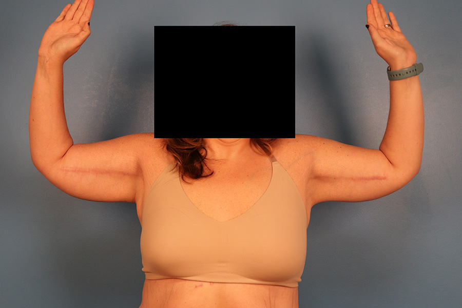 Case--1912 | After Brachioplasty